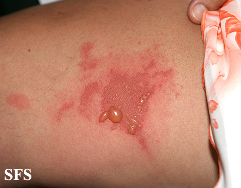 Phytophotodermatitis. With permission from Dermatology Atlas.[21]