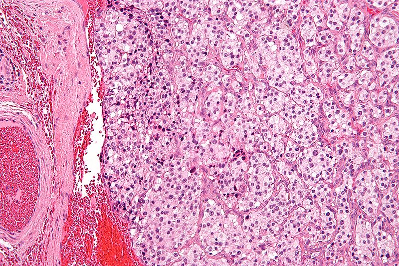 Carotid body tumor higher magnification[4]