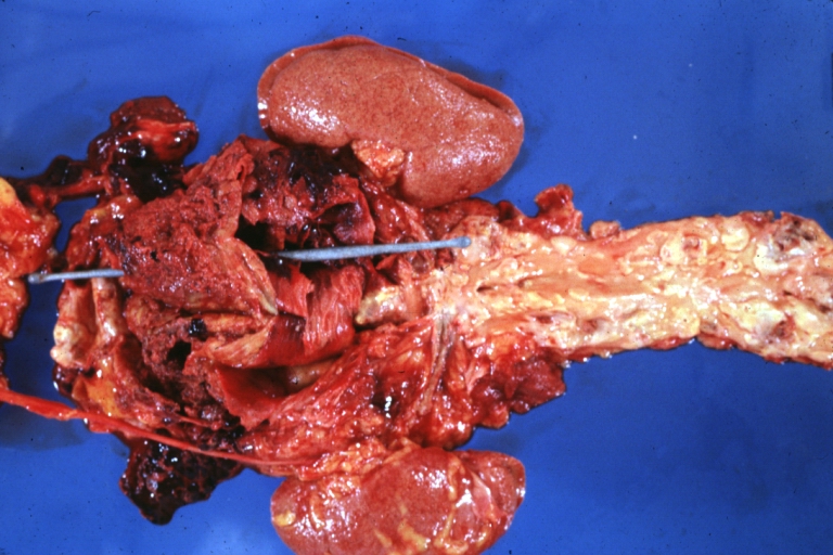 Atherosclerosis: Abdominal Aneurysm Ruptured: Gross, a good example, opened kidneys in marked place. Atherosclerosis in lower thoracic aorta