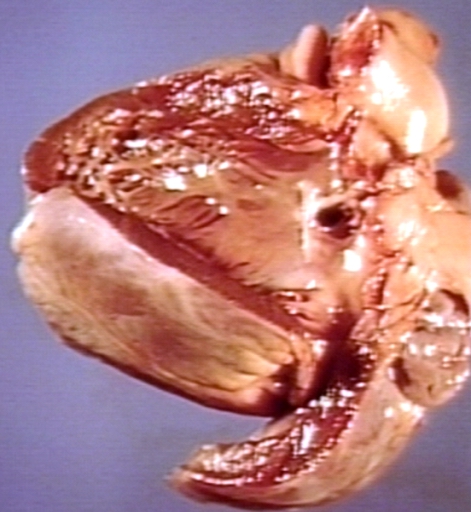 Ventricular septal defect, view from left ventricle