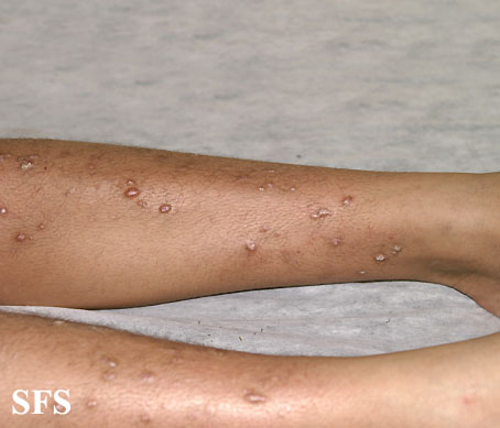Prurigo nodularis. Adapted from Dermatology Atlas.[9]