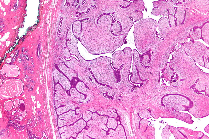 File:800px-Phyllodes tumour - very low mag.jpg