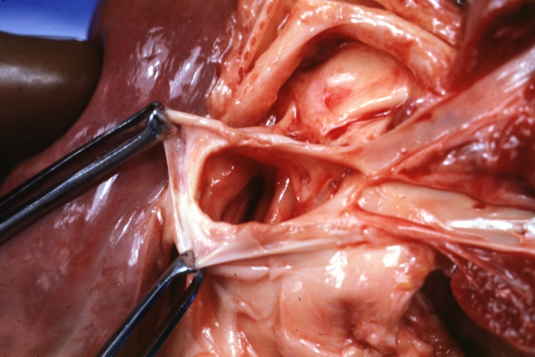 Pulmonary vein stenosis: Gross, natural color, close-up view of two veins entering atrium