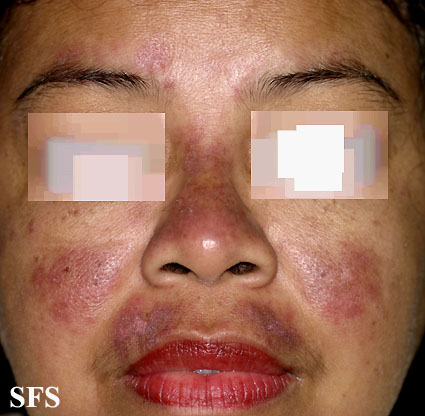 Systemic lupus erythematosus. Adapted from Dermatology Atlas.[6]