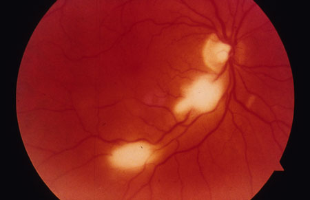 Toxoplasma gondii Retinal Lesions Image obtained from U.S. Department of Veterans Affairs - Image Library [14] (Paul A. Volberding, MD, University of California San Francisco)