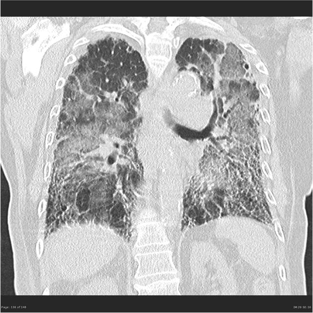 File:Advanced Pulmonary fibrosis CT.jpeg