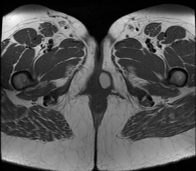 File:Bartholin's gland cyst 003.jpg