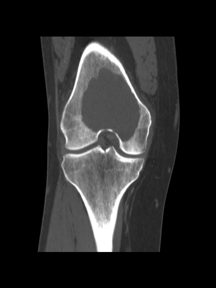 File:CT giant cell tumor.gif