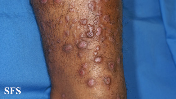 File:Epidermolysis bullosa pruriginosa29.jpg
