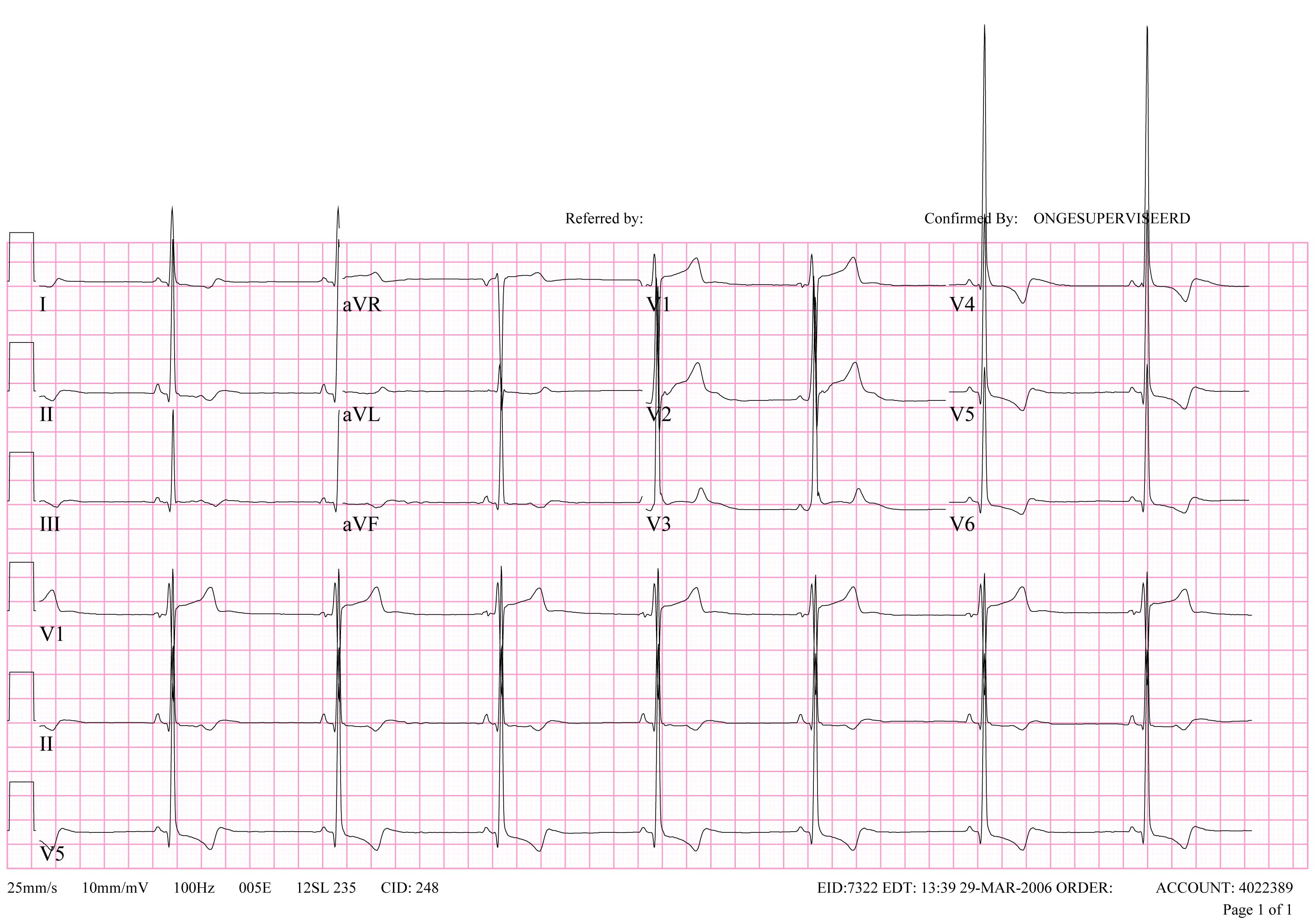 ECG of patient with left ventricular hypertrophy according to the Sokolow-Lyon criteria