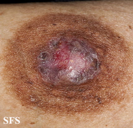 Paget's disease. Adapted from Dermatology Atlas.[3]