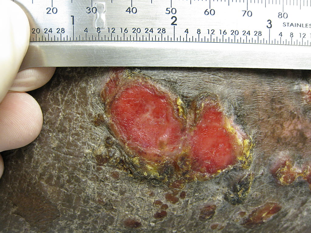 Plaque of mycosis fungoides