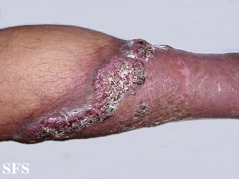 Pyoderma gangrenosum. Adapted from Dermatology Atlas.[5]