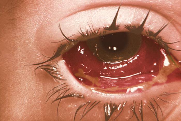 Right eye of a 6 year-old child, who'd been accidentally inoculated with the vaccinia virus, and subsequently developed these severe conjunctival vaccinial lesions. The child had received a primary vaccination, and inadvertently transferred the vaccinial virus to his/her own eye.Adapted from Public Health Image Library (PHIL), Centers for Disease Control and Prevention.[3]