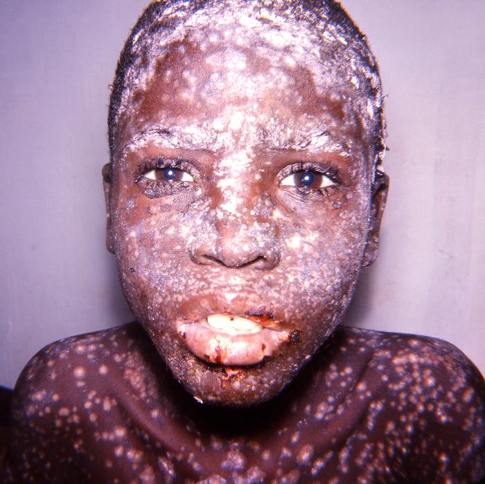 Face of a smallpox patient, displaying the characteristic maculopapular rash due to this viral disease.Adapted from Public Health Image Library (PHIL), Centers for Disease Control and Prevention.[3]
