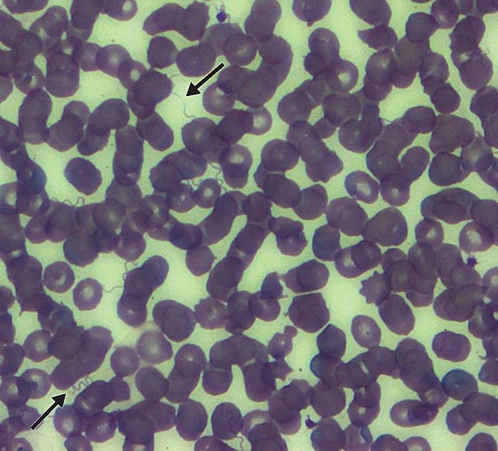 Peripheral blood from a newborn child indicates the presence of numerous Borrelia hermsii spirochetes (arrows), consistent with a tickborne relapsing fever (TBRF) infection. From Public Health Image Library (PHIL). [14]