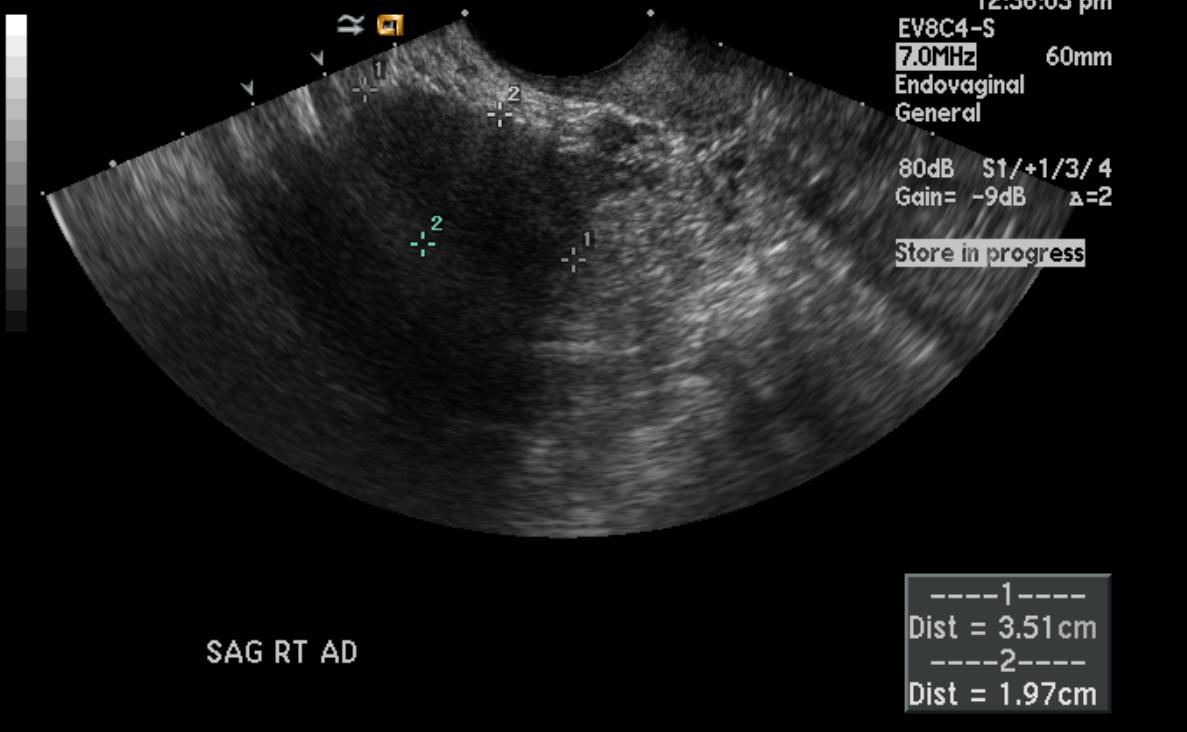 File:Ovarian fibroma ultrasound 002.jpg