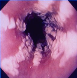 File:Candida esophagitis.jpg