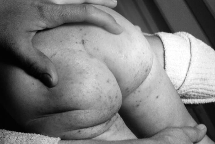 Buttocks and upper thighs of a 2 year-old child, who after having received a smallpox vaccination, sustained what is termed an “accidental implantation” of the newly-introduced vaccinia virus.Adapted from Public Health Image Library (PHIL), Centers for Disease Control and Prevention.[3]