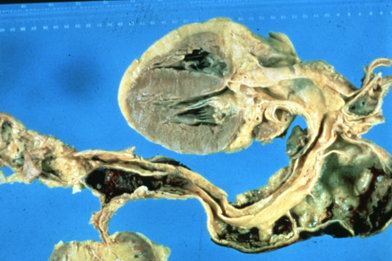 Dissecting Aneurysm: Gross, of heart and aorta with dissection and large false channel (a good example)