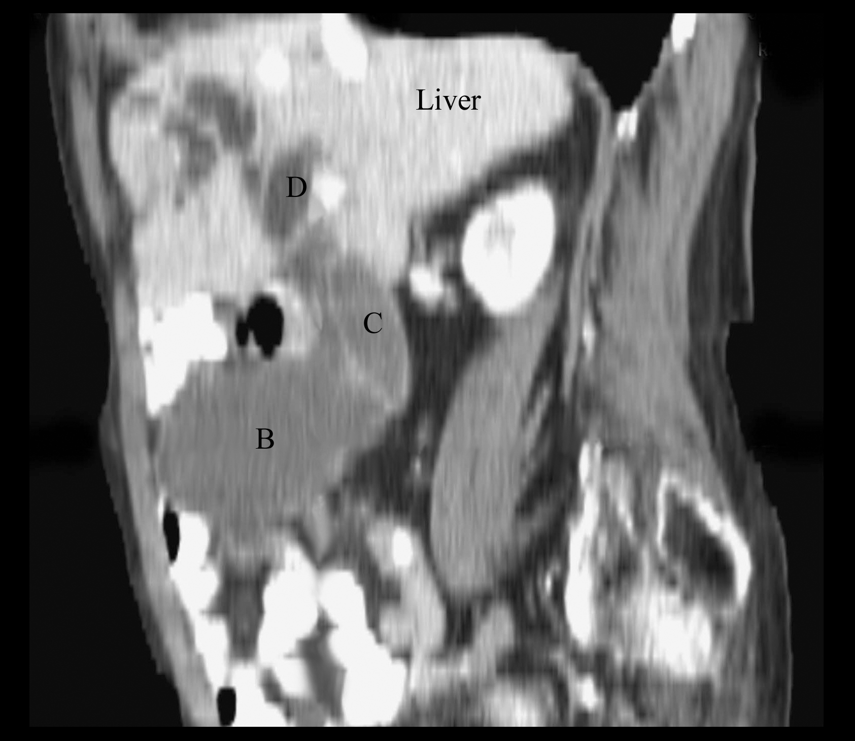 CT sagital image demonstrates dilated gall bladder (B), dilated common bile duct (C), and dilated intrahepatic ducts (D). Courvoisier described the same findings in patients with pancreatic cancer.