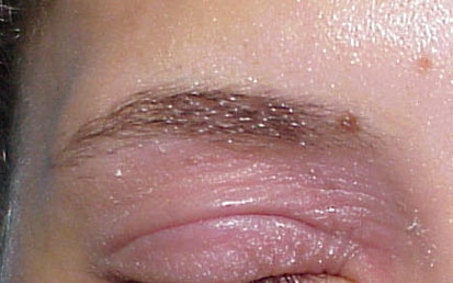 File:Nail polish dermatitis06.jpg