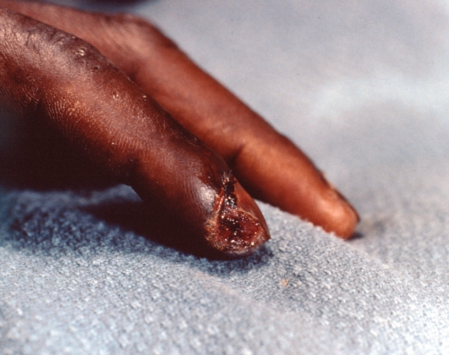 Necrosis of distal finger in a patient with panniculitis and fascitis, streptococcus A septicemia in a patient with Scleroderma who was on high dose steroids