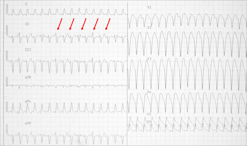 Wide complex tachycardia. LBBB configuration. Absence of RS in the chest leads. AV dissociation is present. Conclusion: VT