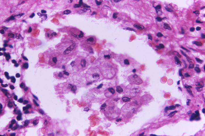 Photomicrograph of a lung lesion tissue specimen, reveals some morphology associated with the disease cryptococcosis (800x mag). From Public Health Image Library (PHIL). [10]