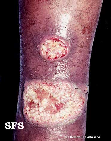 Cutaneous leishmaniasis. Adapted from Dermatology Atlas.[1]