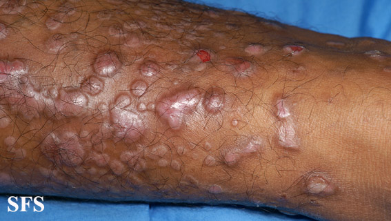 File:Epidermolysis bullosa pruriginosa30.jpg