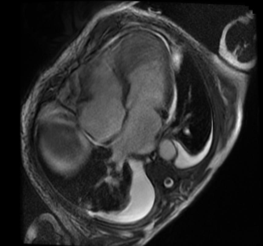 MRI: A large left ventricular clot in patient with acute myocardial infarction.
