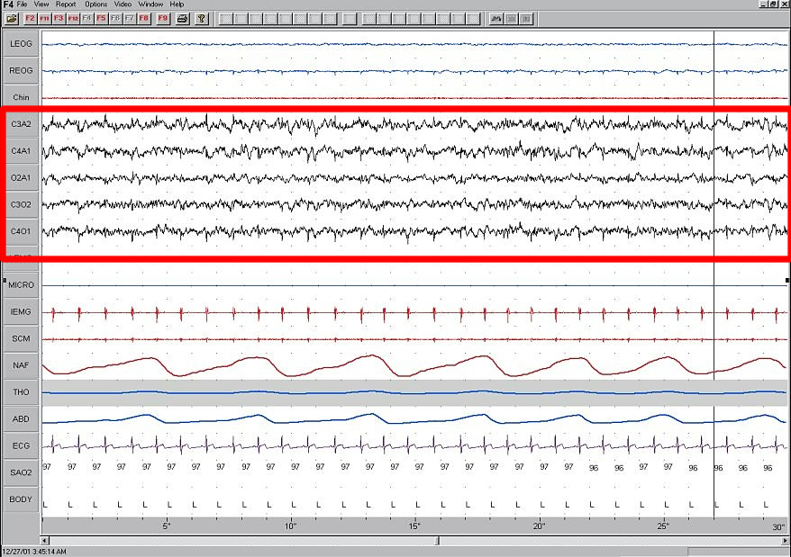 File:Sleep EEG Stage 1.jpg