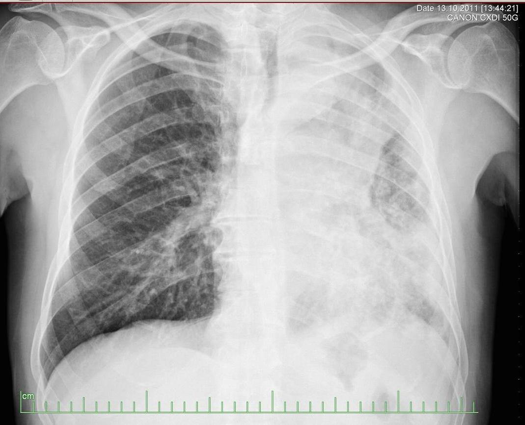 Chest x-ray: Small cell carcinoma of the lung. Five weeks later.