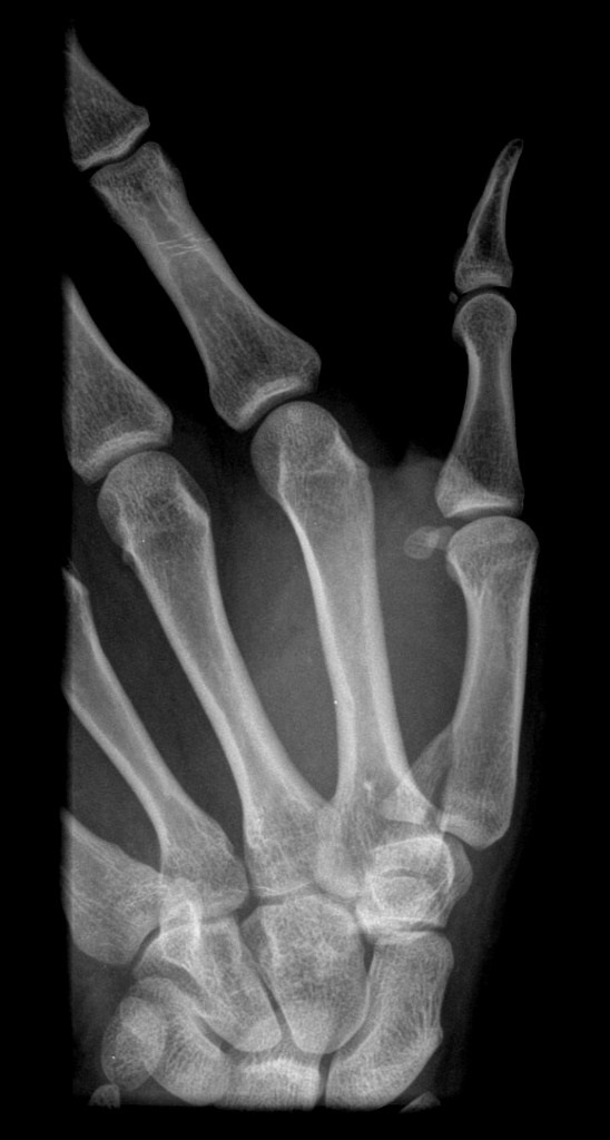 Intra-articular fracture and dislocation of the base of the 1st metacarpal.