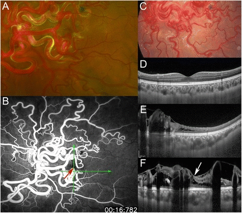 Fundus photographs , fluorescein angiographic (FA) image, and enhanced depth imaging optical coherence tomographic (EDI- OCT)
