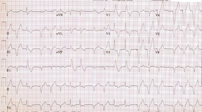 Multifocal Atrial Tachycardia, p waves of 3 different morphologies