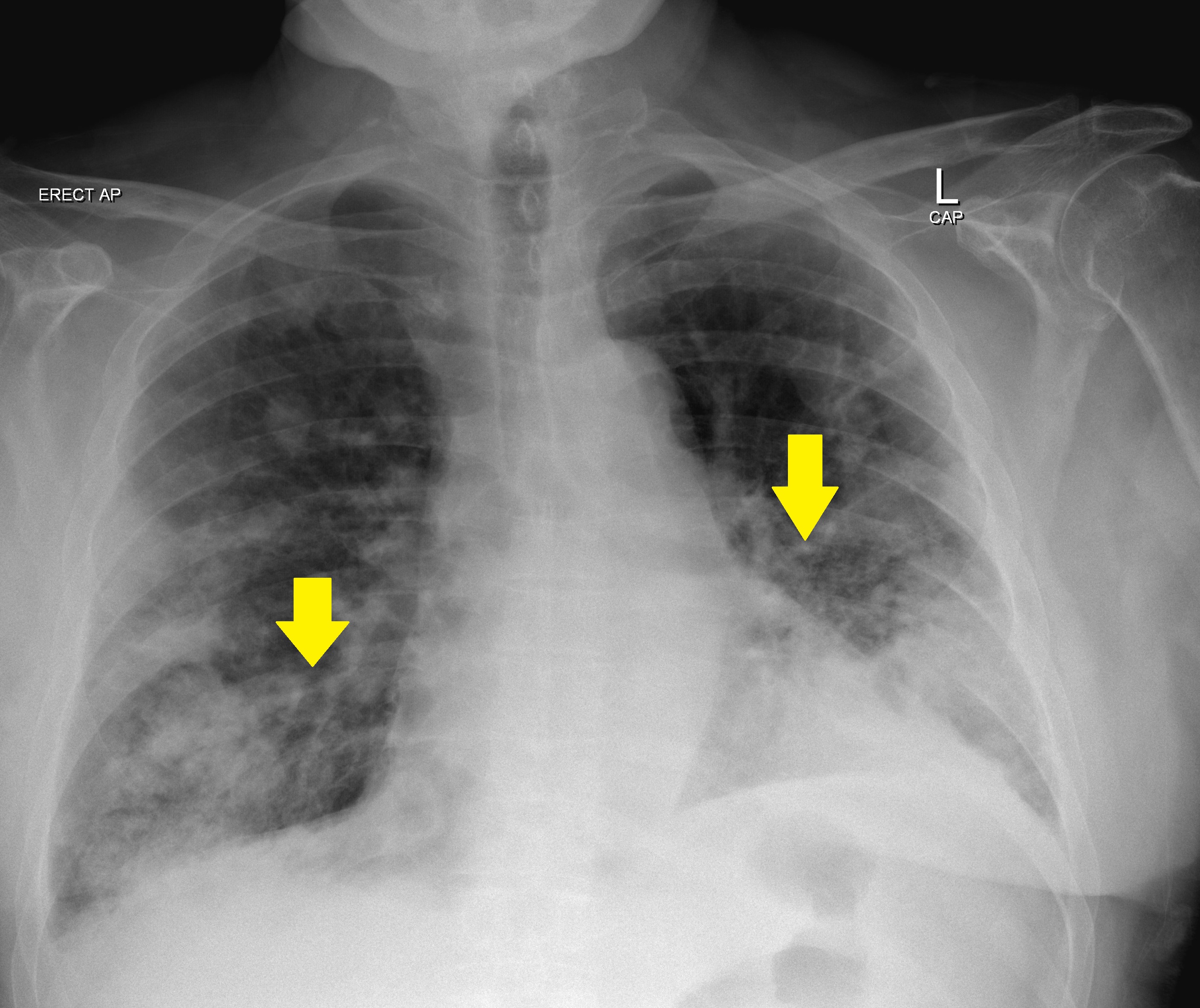 File:Nodular-pulmonary-amyloidosis-3.jpg