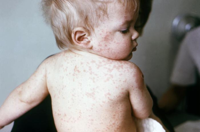 Face and back of a young child after receiving a smallpox vaccination in the right shoulder region. Note the erythematous halo surrounding the vaccination site and morbilliform skin rash, i.e., resembling measles(numerous flattened erythematous, amorphous macules)Adapted from Public Health Image Library (PHIL), Centers for Disease Control and Prevention.[3]