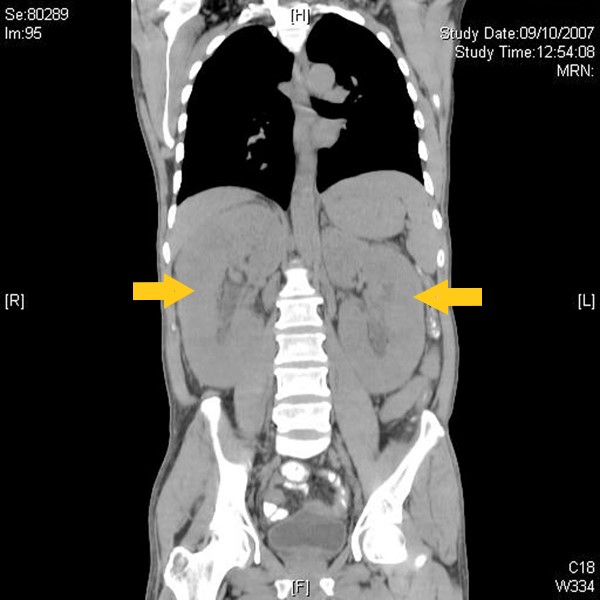 File:Abdominal CT scan (Angioimmunoblastic).jpg