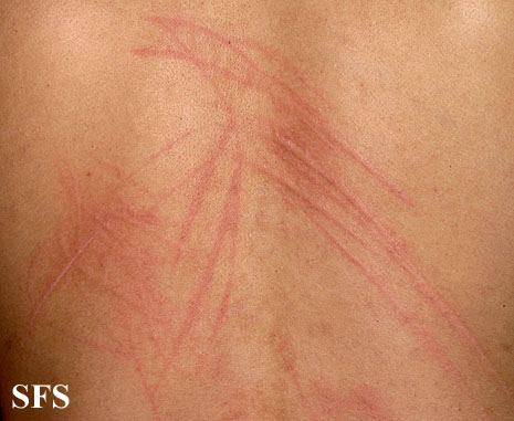 Dermatographic urticaria. Adapted from Dermatology Atlas.[3]