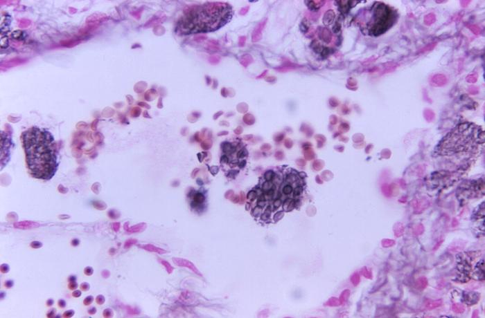 Methenamine silver-stained photomicrograph of a lung lesion tissue specimen, reveals some morphology associated with the disease cryptococcosis (800X mag). From Public Health Image Library (PHIL). [10]