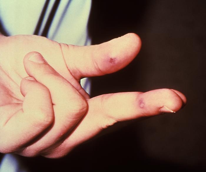 The lesion on the left hand due to the systemic dissemination of the Neisseria gonorrhea.