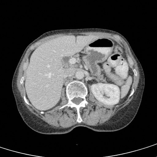 File:Pancreatic fistula CT.jpg