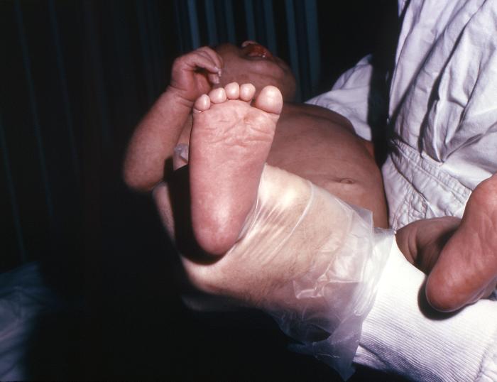 Plantar surface of the right foot of a 5 week-old Washington State male patient who after receiving a smallpox vaccination, developed an erythema multiforme reaction. In this particular view, note how the maculopapular rash had spread to his the plantar surface of his right foot. Adapted from Public Health Image Library (PHIL), Centers for Disease Control and Prevention.[14]