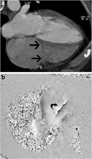 Tricuspid stenosis in CT and MRI