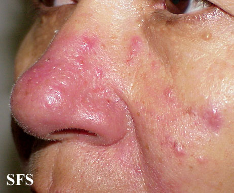 Acne rosacea. Adapted from [http://www.atlasdermatologico.com.br/disease.jsf?diseaseId=6