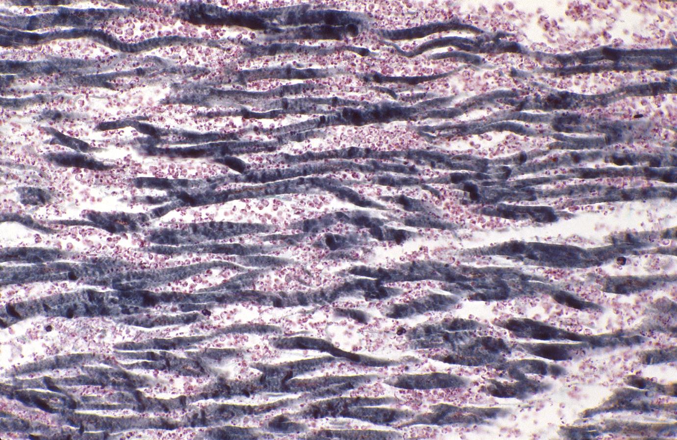 Acute myocardial infarction, ischemic fibers demonstrated by aldehyde fuchsin stain