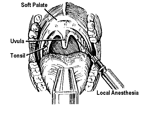 Local anesthesia. A topical anesthetic spray and an injection of lidocaine are used to numb the soft palate and uvula[2].