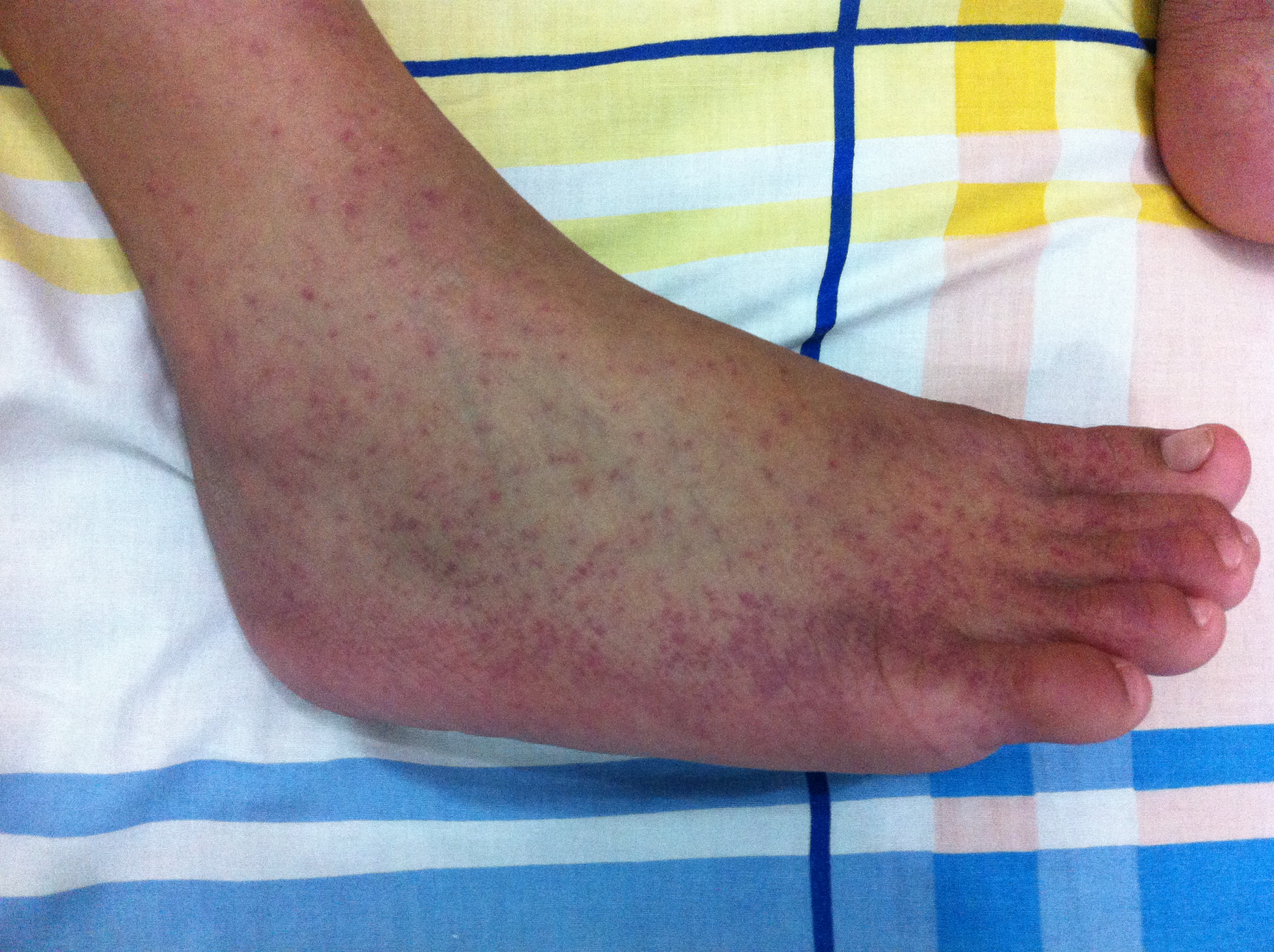 Maculopapular rash in the feet